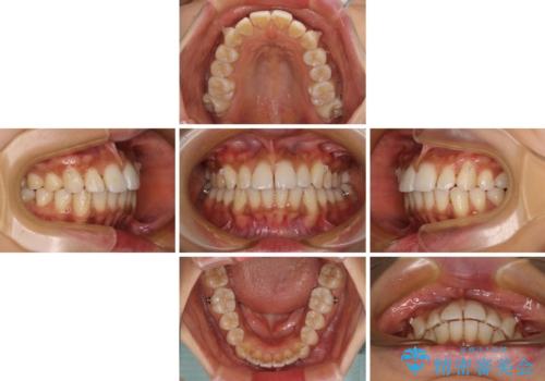 カリエール・ディスタライザーを併用したインビザライン矯正治療の治療中