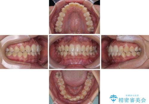 前歯のデコボコと隠れてしまう下顎前歯 インビザラインですっきりと改善の治療中