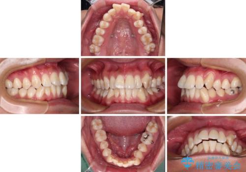 補助装置を併用してスムーズに インビザラインによる矯正治療の治療中