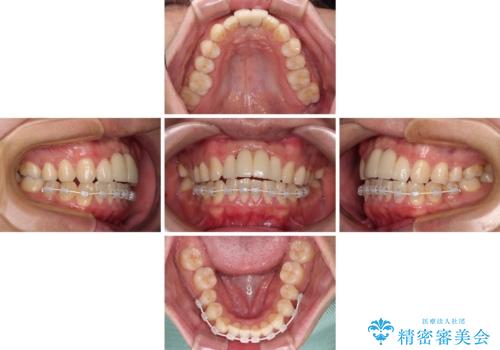 下顎前歯の部分矯正 目立たないワイヤー装置の治療中