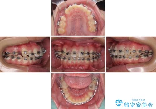 前歯のデコボコとむし歯だらけの歯列 矯正治療と虫歯治療の治療中
