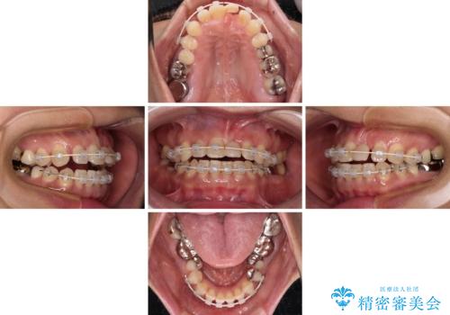 中途半端な矯正治療と前歯の欠損 再矯正とオールセラミッククラウンによる補綴治療の治療中