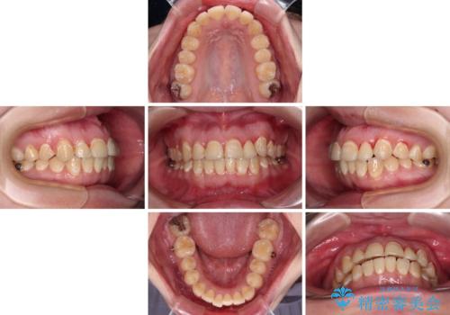 前歯のクロスバイトを改善 ワイヤー矯正を併用したインビザライン矯正の治療中