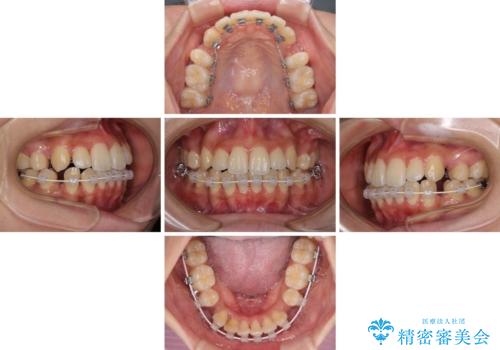 目立たないハーフリンガル矯正　抜歯矯正で口元の突出感を改善の治療中