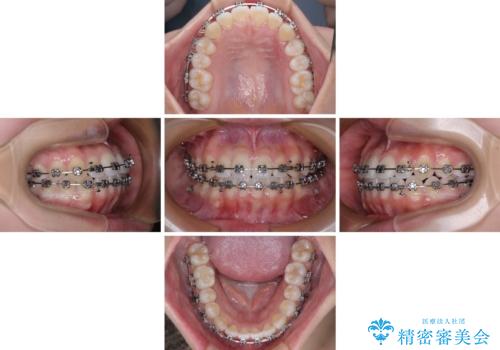 前歯のデコボコを楽して改善 ワイヤー装置による矯正治療の治療中