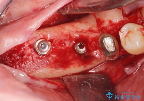 歯周病により抜去した歯のインプラント治療の治療中