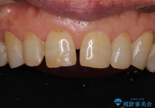 前歯の隙間をオールセラミッククラウンで自然にの治療前