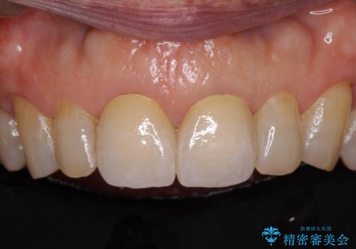 前歯の隙間をオールセラミッククラウンで自然にの治療後