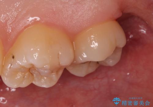 歯の高さを出すための親知らず抜歯と歯肉切除の治療後