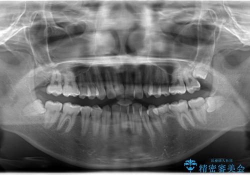 【インビザライン】 前歯の反対咬合を治したいの治療前