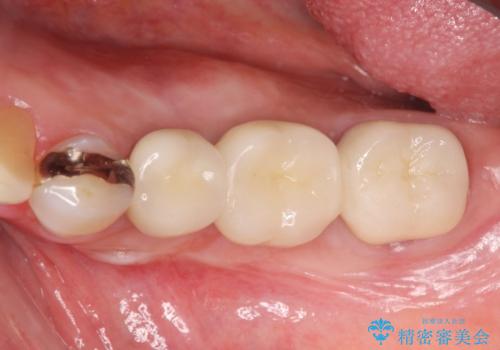 下顎骨隆起を用いた骨造成・インプラント補綴の治療後