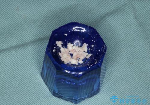 下顎骨隆起を用いた骨造成・インプラント補綴の治療中