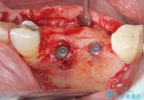 下顎骨隆起を用いた骨造成・インプラント補綴の治療中