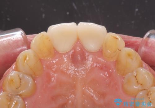 前歯の隙間をオールセラミッククラウンで自然にの治療後