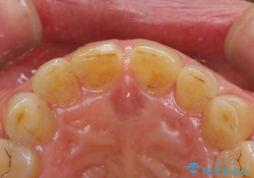 前歯の隙間をオールセラミッククラウンで自然にの治療前