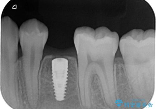 小臼歯のインプラントの治療前