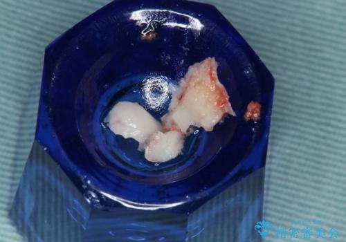 下顎骨隆起を用いた骨造成・インプラント補綴の治療中