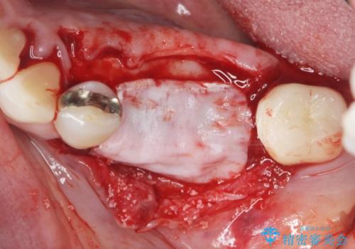 下顎骨隆起を用いた骨造成・インプラント補綴の治療中