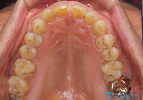 前歯の隙間をオールセラミッククラウンで自然にの治療前