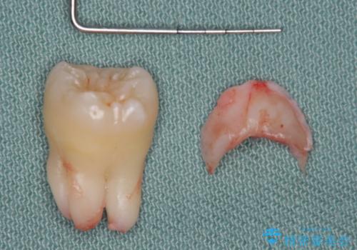 歯の高さを出すための親知らず抜歯と歯肉切除の治療後