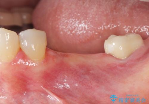 下顎骨隆起を用いた骨造成・インプラント補綴の症例 治療前