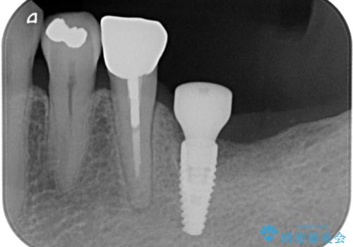 【インプラント】銀歯が取れて歯ごと折れたの治療中