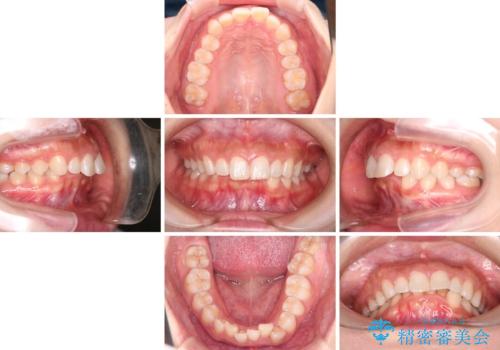 上の出っ歯を治したい インビザラインによる矯正治療の治療前