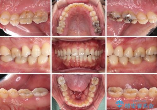 歯肉が腫れて出血する奥歯 歯周外科処置を用いたセラミック補綴治療の治療前