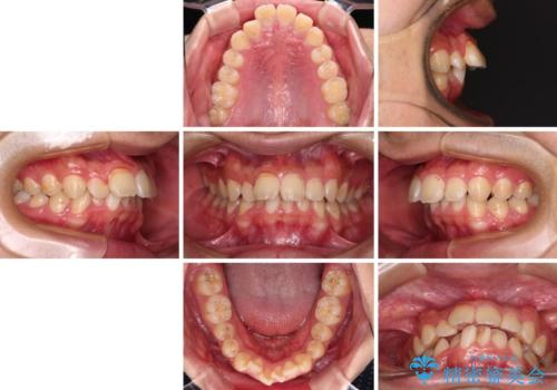 【モニター】飛び出した上の前歯 ワイヤー装置を併用してインビザラインできれいにの治療前