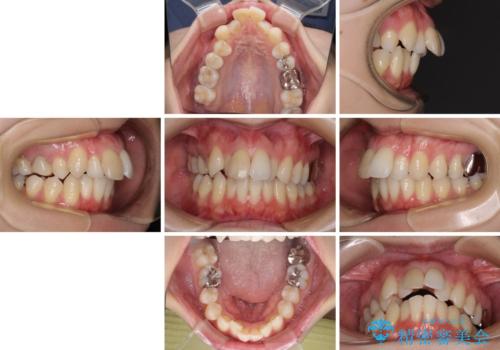 V字型に飛び出した前歯 ワイヤー装置での抜歯矯正の治療前