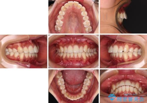 カリエール・ディスタライザーを併用したインビザライン矯正治療の治療前