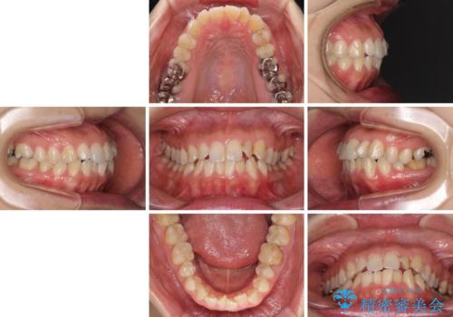 【モニター】上下前歯の叢生を解消　インビザライン矯正治療の治療前