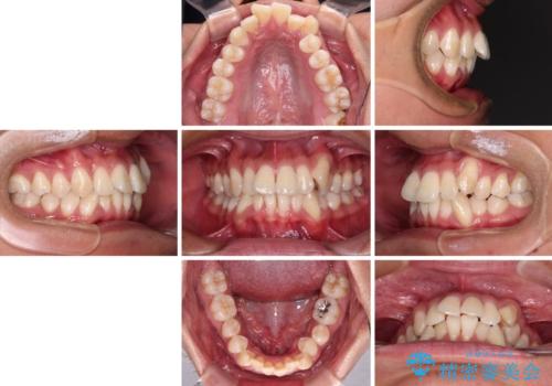 補助装置を併用してスムーズに インビザラインによる矯正治療の治療前