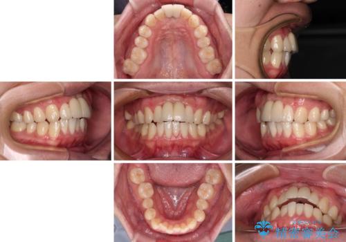 下顎前歯の部分矯正 目立たないワイヤー装置の治療前