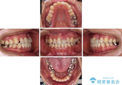 中途半端な矯正治療と前歯の欠損 再矯正とオールセラミッククラウンによる補綴治療の治療前