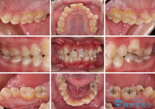 前歯のデコボコとむし歯だらけの歯列 矯正治療と虫歯治療の治療前