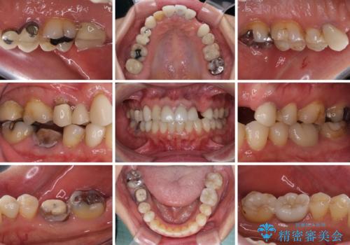 欠損やむし歯の歯をきれいなセラミックに　全顎虫歯治療の治療前