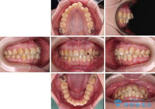 前歯のクロスバイトを改善 ワイヤー矯正を併用したインビザライン矯正の治療前