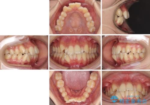 目立たないハーフリンガル矯正 抜歯矯正で口元の突出感を改善の治療前