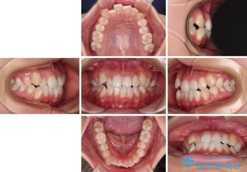 前歯のデコボコを楽して改善 ワイヤー装置による矯正治療の治療前