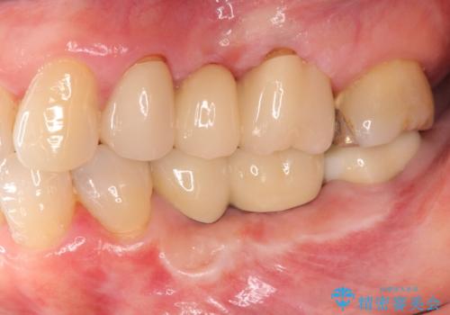 下顎骨隆起を用いた骨造成・インプラント補綴の治療後