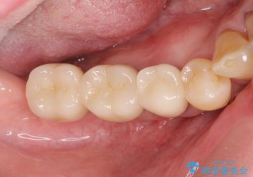 歯周病により抜去した歯のインプラント治療の治療後