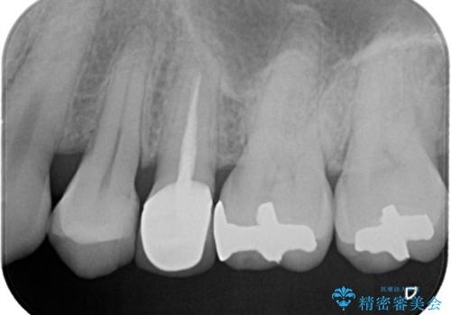 【セラミッククラウン】他院で入れた被せ物を変えたい。の治療後