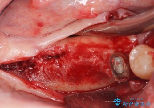 歯周病により抜去した歯のインプラント治療の治療中