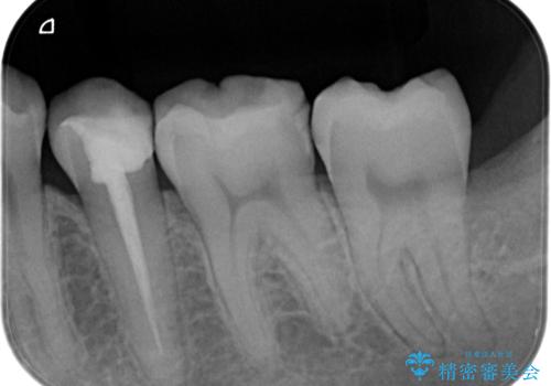 【オールセラミッククラウン】根管治療した歯の被せ物治療の治療前