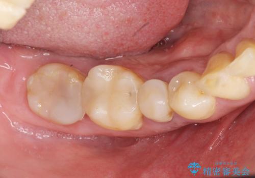 歯周病により抜去した歯のインプラント治療の治療前