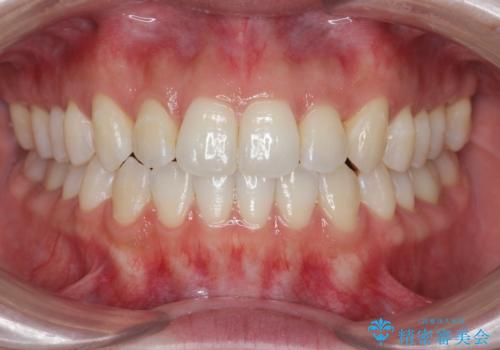 [ インビザライン ]  前歯のガタつきをマウスピース矯正で改善の治療後