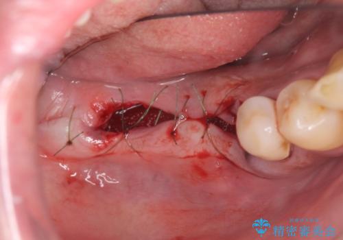 歯周病により抜去した歯のインプラント治療の治療前