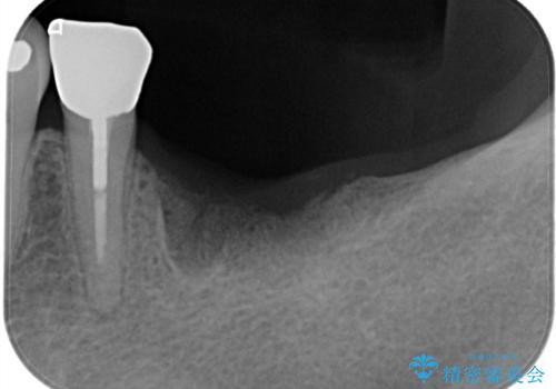 【インプラント】銀歯が取れて歯ごと折れたの治療前