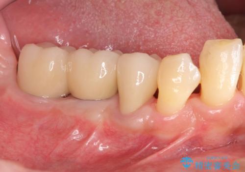 歯周病により抜去した歯のインプラント治療の症例 治療後